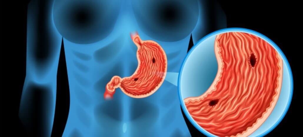 Here are 5 early warning signs of stomach tumour you shouldn