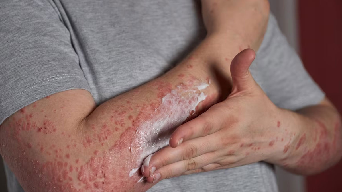 Men are twice as likely as women to develop psoriasis: Experts