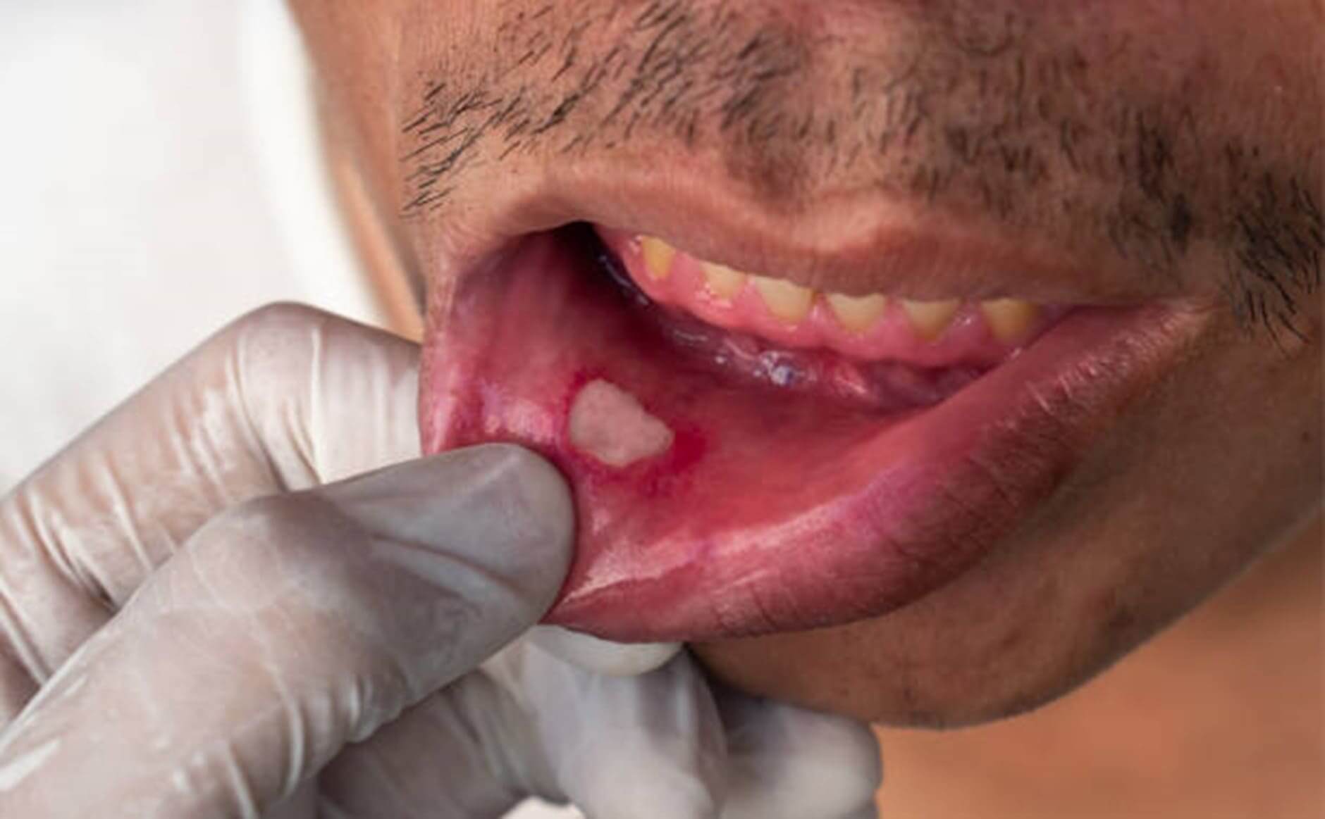 Recurring mouth ulcers can be a warning sign for underlying health issues