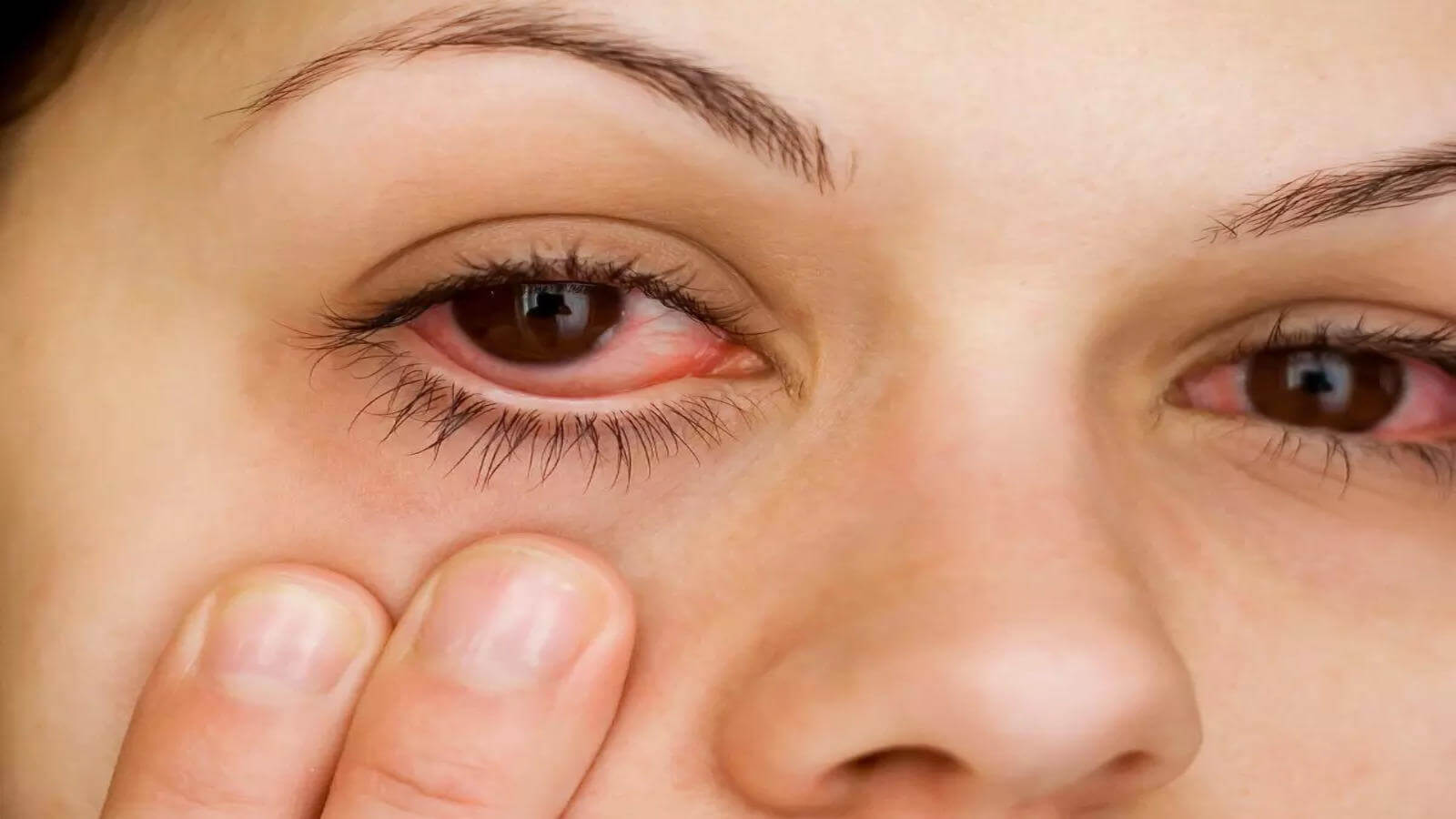 Know effective tips to prevent pink eyes during rainy season