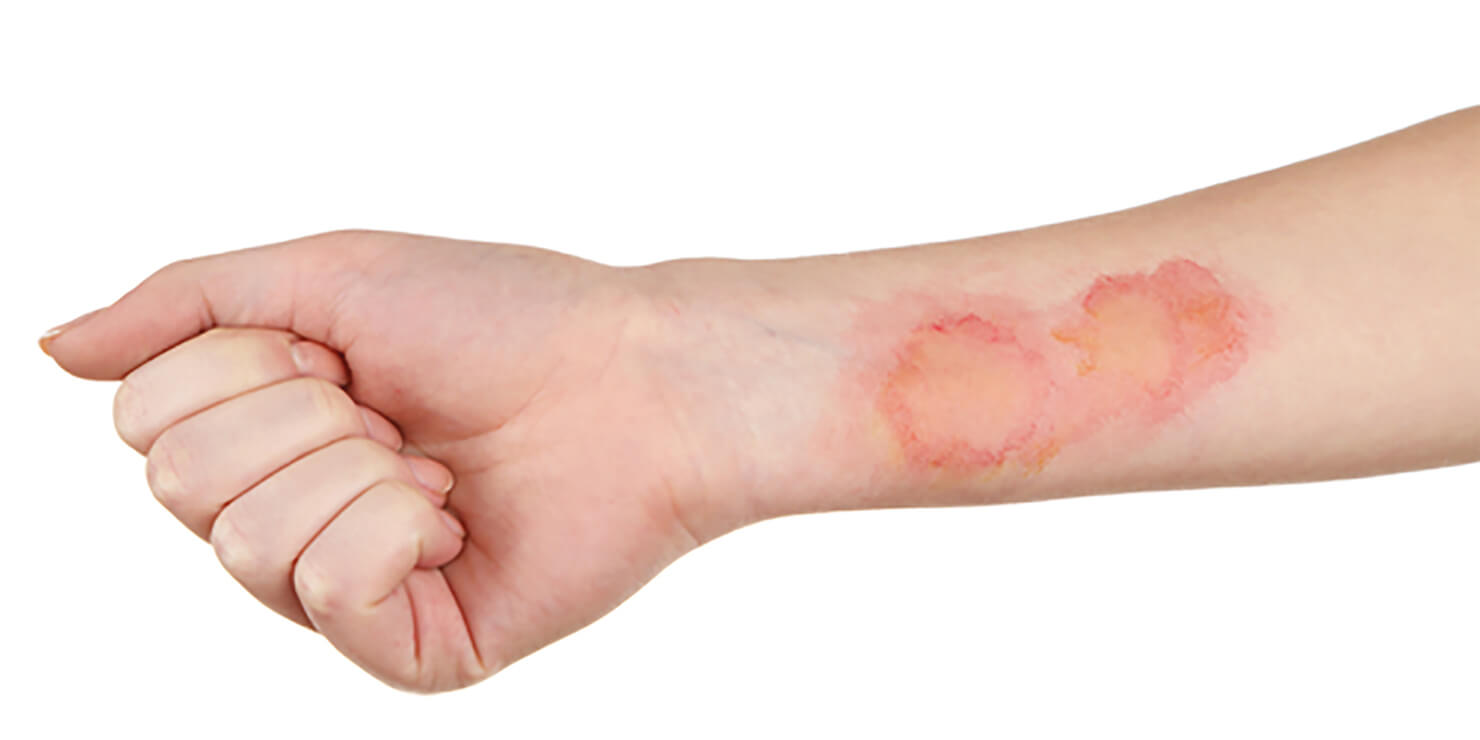 Try these home remedies to treat a burn wound