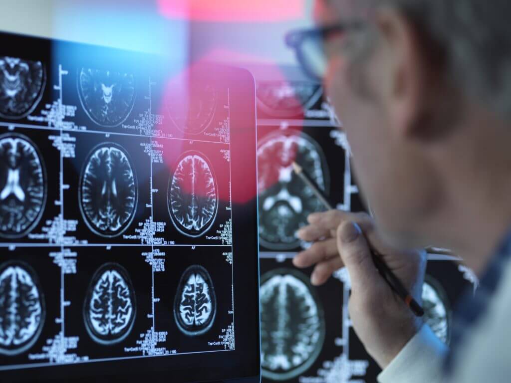 Vascular changes in brain linked to Alzheimer