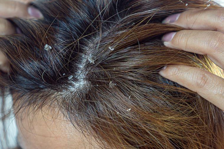 Know symptoms of excessive itching on scalp can be caused due to infection