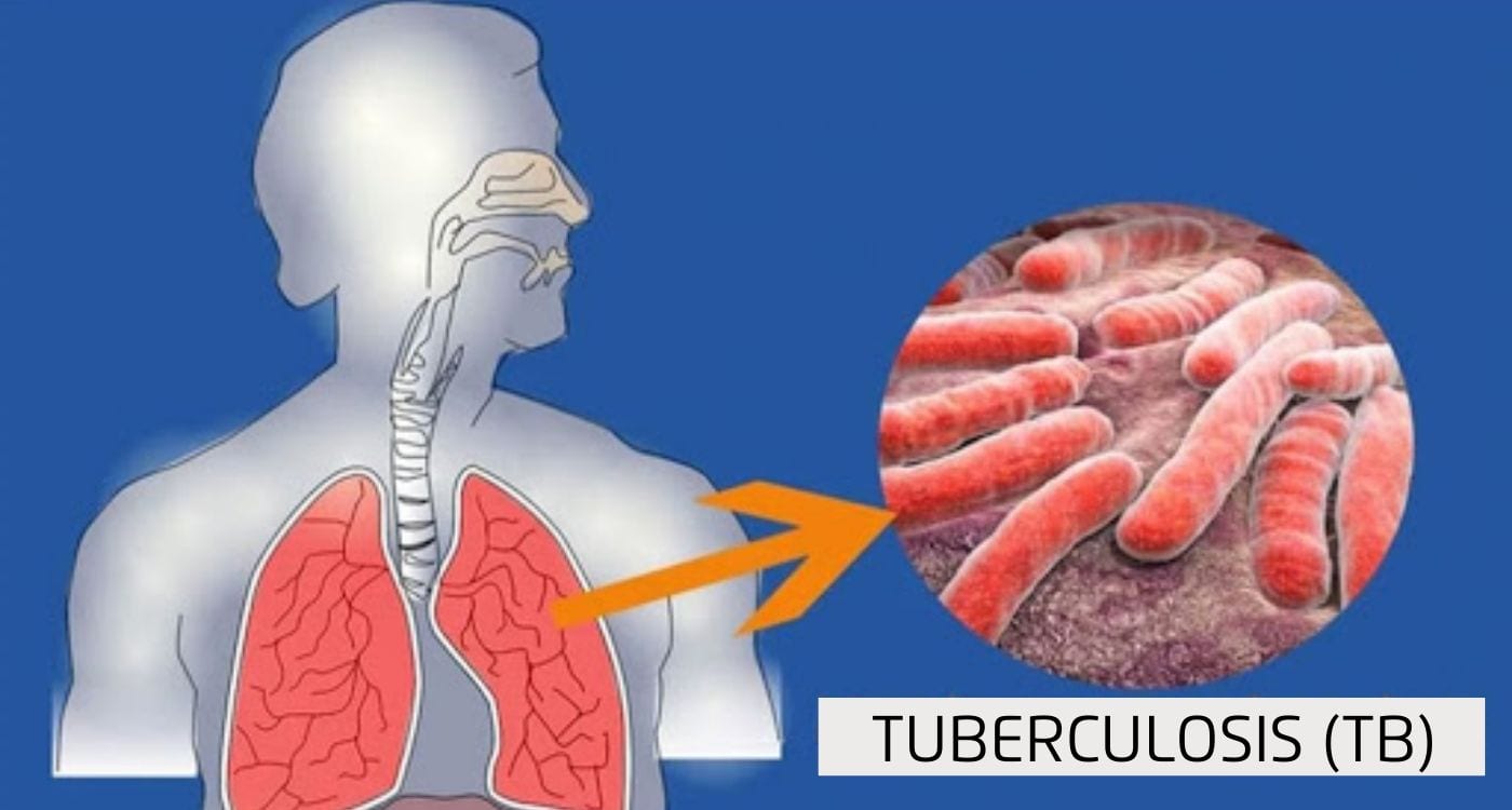 Nationwide 100-day TB eradication campaign launched