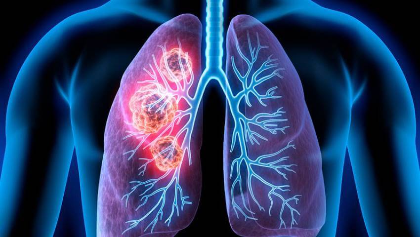 Bad air quality increases risk of lung cancer in non-smokers: Lancet study