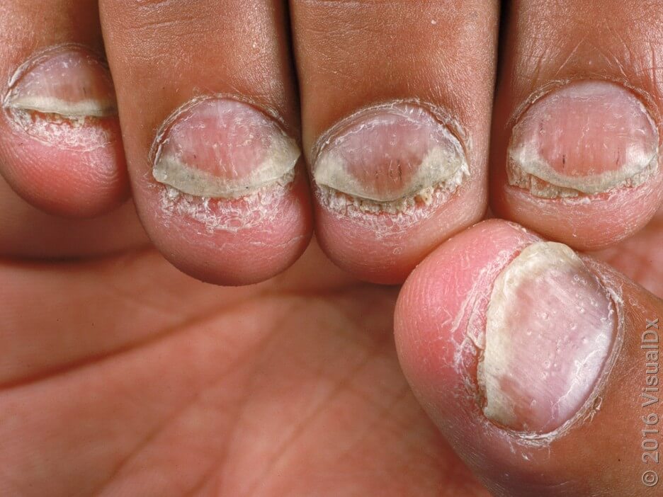 know5unusualsignsofnailpsoriasis