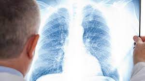 Here are 6 early signs of lung cancer that can help in diagnosis