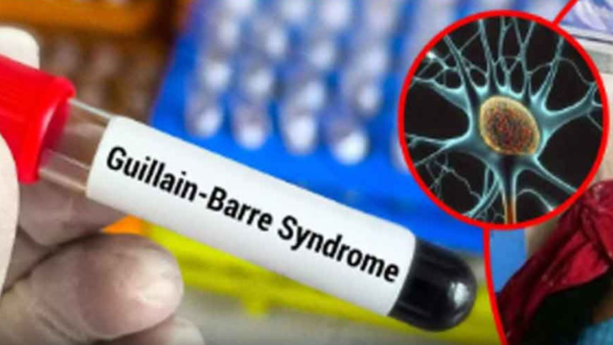 Maharashtra Reports 3 New Suspected Cases of Guillain-Barré Syndrome; 140 Confirmed Cases So Far