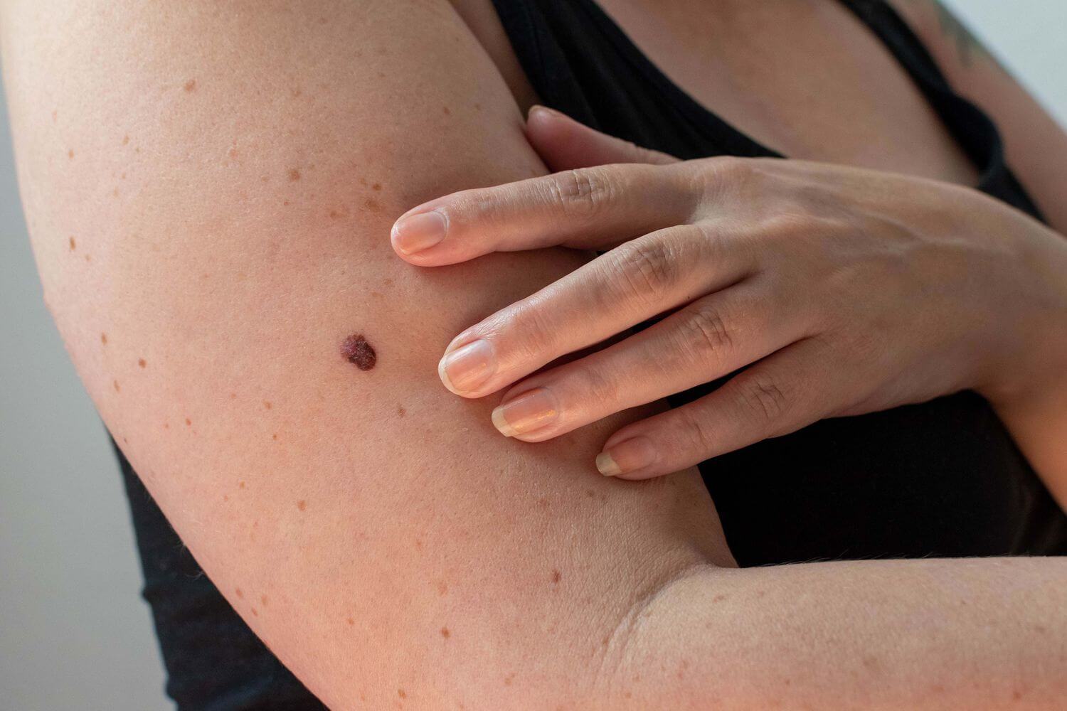 Doctors says, new growth, size and colour of moles may be skin cancer
