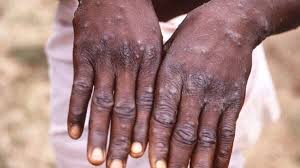 Death Toll from Monkeypox Outbreak in Africa Reaches 979