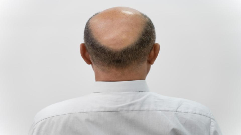 Bald man’s miraculous ‘hair growth’ formula in Meerut lands him in jail!