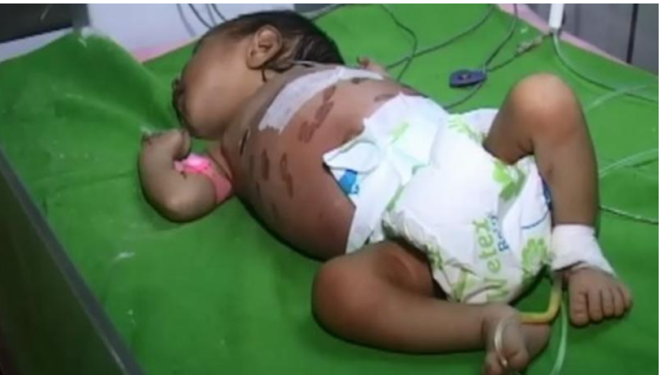 One Month-old-baby branded with hot iron rod for 40 times to cure disease in Odisha